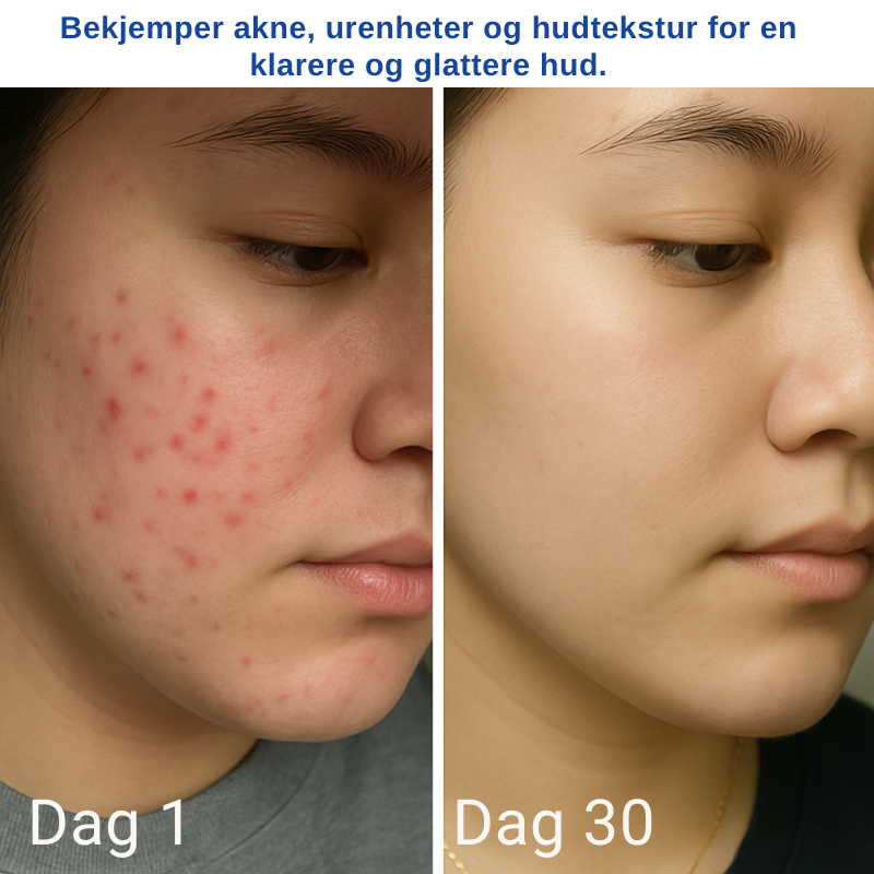 Excellent A313 Hudforyngelse