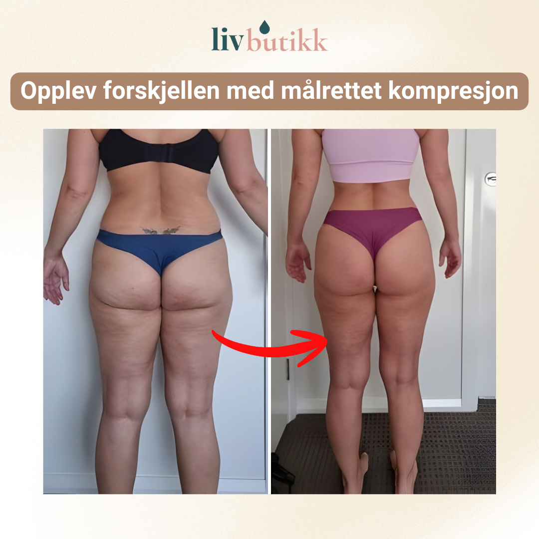 NOVA | 3D Kompresjonsleggings for Lipødem Komfort