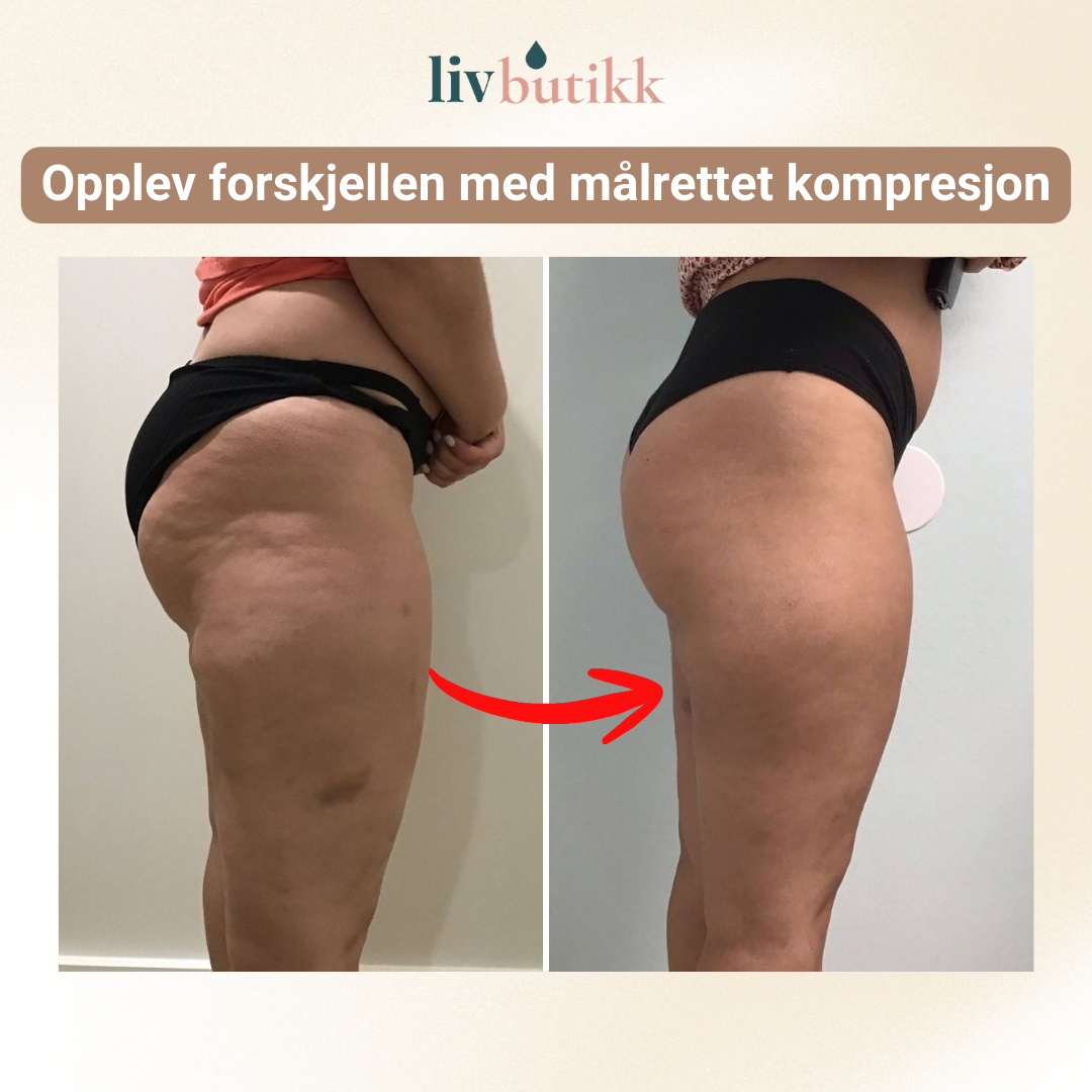 NOVA | 3D Kompresjonsleggings for Lipødem Komfort