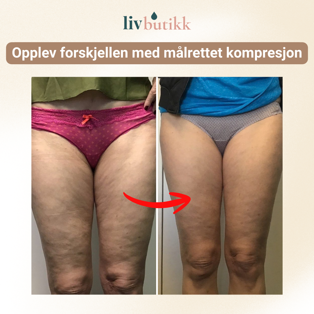 NOVA | 3D Kompresjonsleggings for Lipødem Komfort